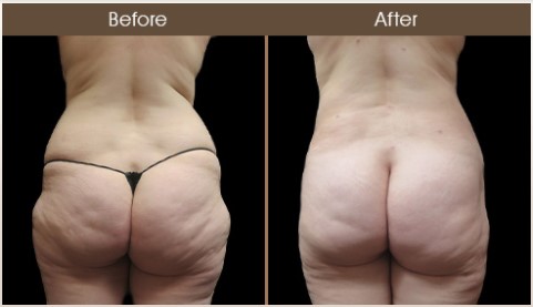 Before And After Gluteal Fat Transfer